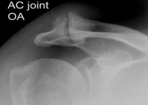 AC Joint Arthritis