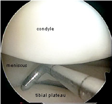 Knee Cartilage3