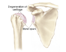 Shoulder Cartilage Degeneration