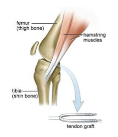 acl tendon graft