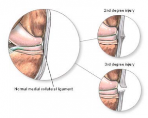 collateral ligament injury