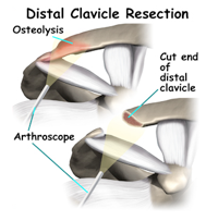 distal clavicle resection
