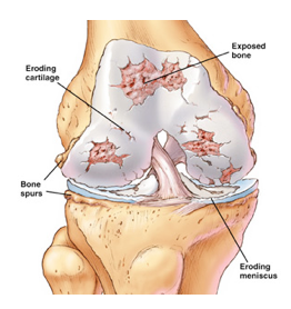 Knee Arthritis Treatment