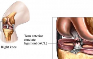 ACL Surgeon Phoenix