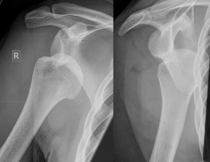 Dislocated_shoulder_X-ray_03
