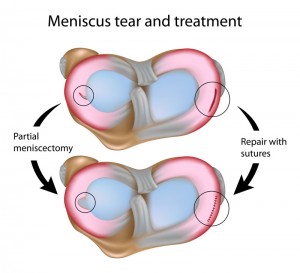 knee pain meniscus picture