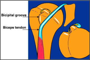 Biceps Tendon Dislocation