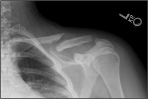 X-ray of Clavicle Fracture