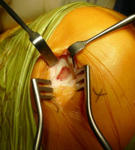 knee cartilage defect