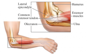 tennis elbow