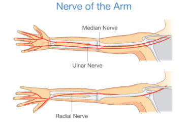 What Is Ulnar Neuritis